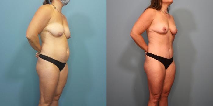 Mommy Makeover Before & After Gallery - Patient 113707 - Image 1