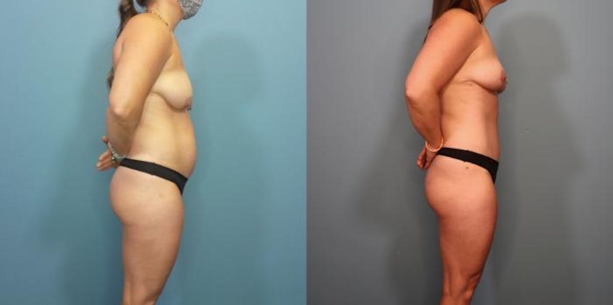 Mommy Makeover Before & After Gallery - Patient 113707 - Image 2