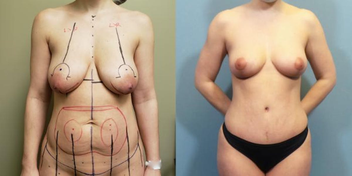 Mommy Makeover Before & After Gallery - Patient 483376 - Image 1