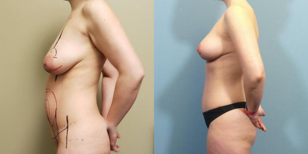 Mommy Makeover Before & After Gallery - Patient 483376 - Image 2