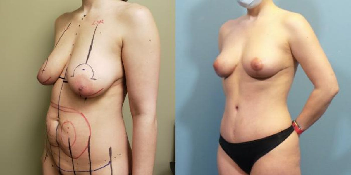 Mommy Makeover Before & After Gallery - Patient 483376 - Image 3