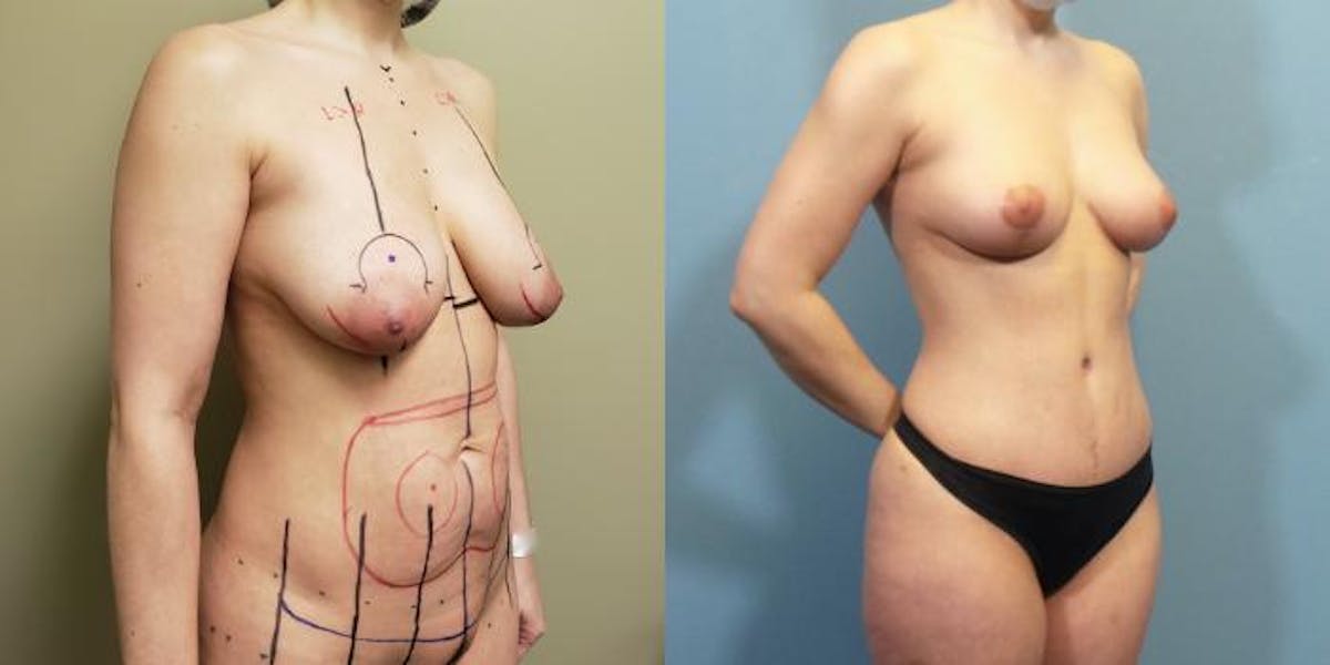 Mommy Makeover Before & After Gallery - Patient 483376 - Image 4