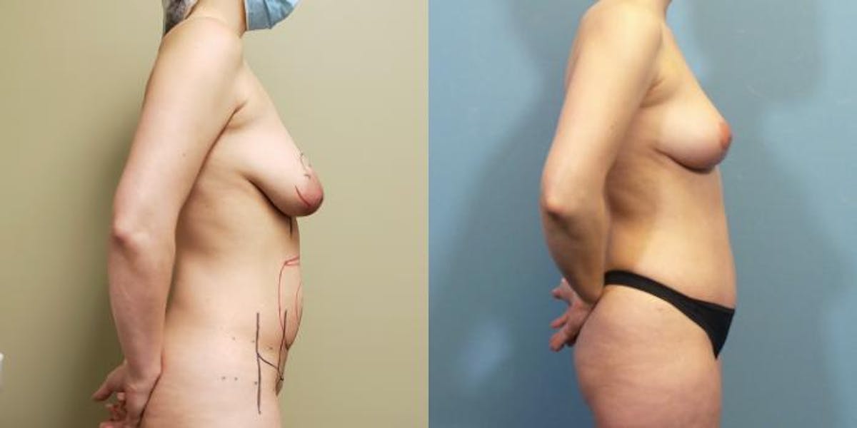Mommy Makeover Before & After Gallery - Patient 483376 - Image 5