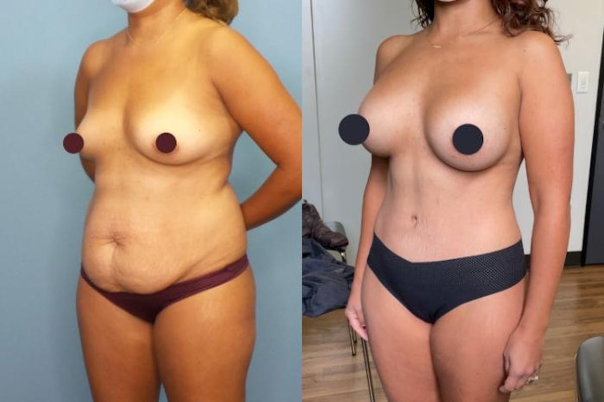 Mommy Makeover Before & After Gallery - Patient 230849 - Image 1