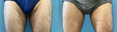 Thigh Lift Before & After Gallery - Patient 364375 - Image 1