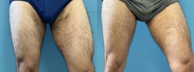 Thigh Lift Before & After Gallery - Patient 364375 - Image 2
