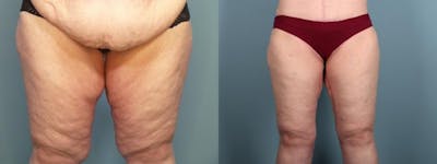 Thigh Lift Before & After Gallery - Patient 109385 - Image 2