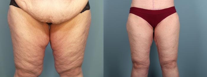 Thigh Lift Before & After Gallery - Patient 109385 - Image 2