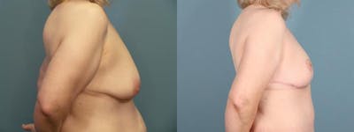 Thigh Lift Before & After Gallery - Patient 109385 - Image 5