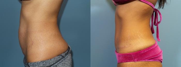 Tummy Tuck (Abdominoplasty) Before & After Gallery - Patient 748794 - Image 1
