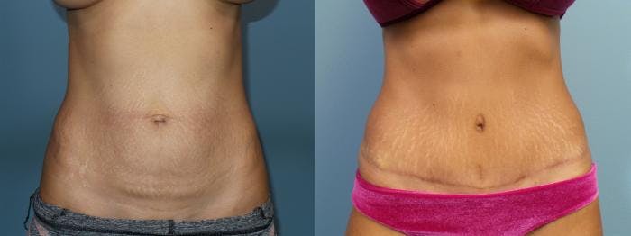 Tummy Tuck (Abdominoplasty) Before & After Gallery - Patient 748794 - Image 2