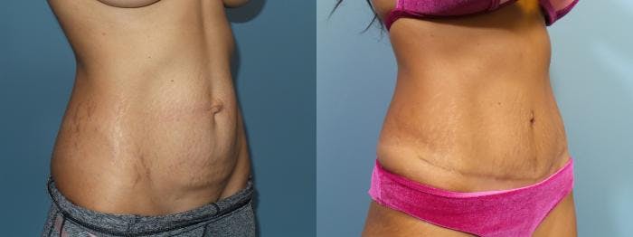 Tummy Tuck (Abdominoplasty) Before & After Gallery - Patient 748794 - Image 3