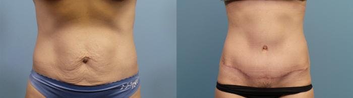 Tummy Tuck (Abdominoplasty) Before & After Gallery - Patient 727641 - Image 1