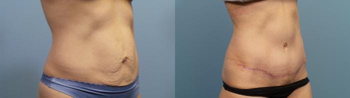 Tummy Tuck (Abdominoplasty) Before & After Gallery - Patient 727641 - Image 2