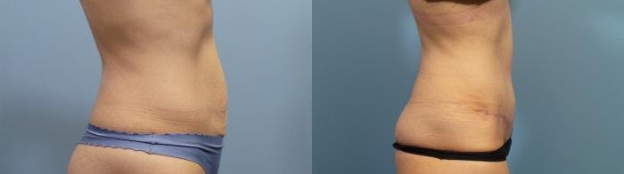 Tummy Tuck (Abdominoplasty) Before & After Gallery - Patient 727641 - Image 3