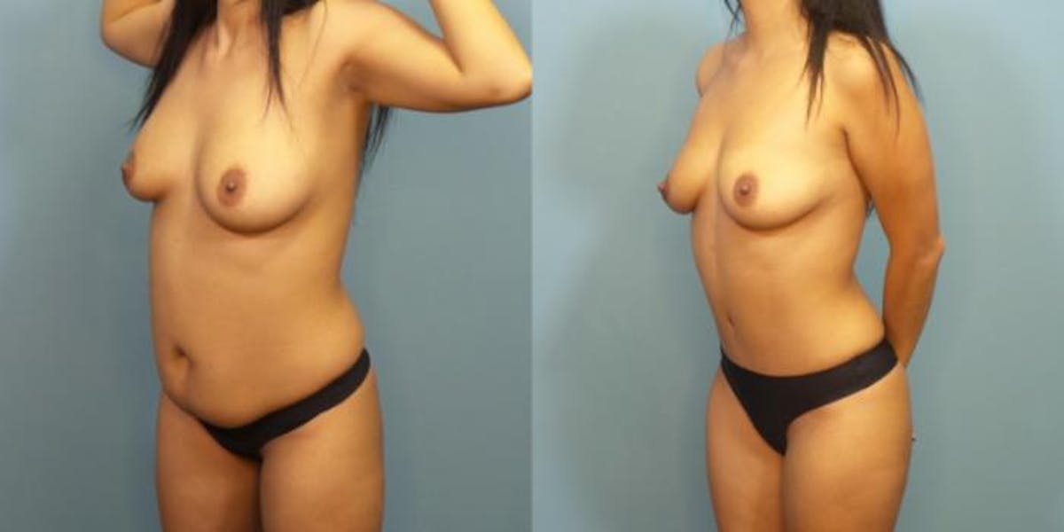 Tummy Tuck (Abdominoplasty) Before & After Gallery - Patient 306914 - Image 1