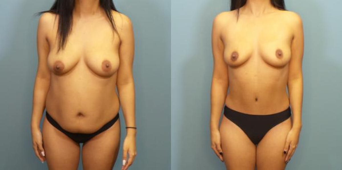 Tummy Tuck (Abdominoplasty) Before & After Gallery - Patient 306914 - Image 2