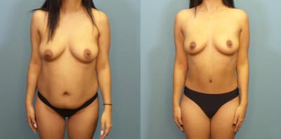 Tummy Tuck (Abdominoplasty) Before & After Gallery - Patient 306914 - Image 2