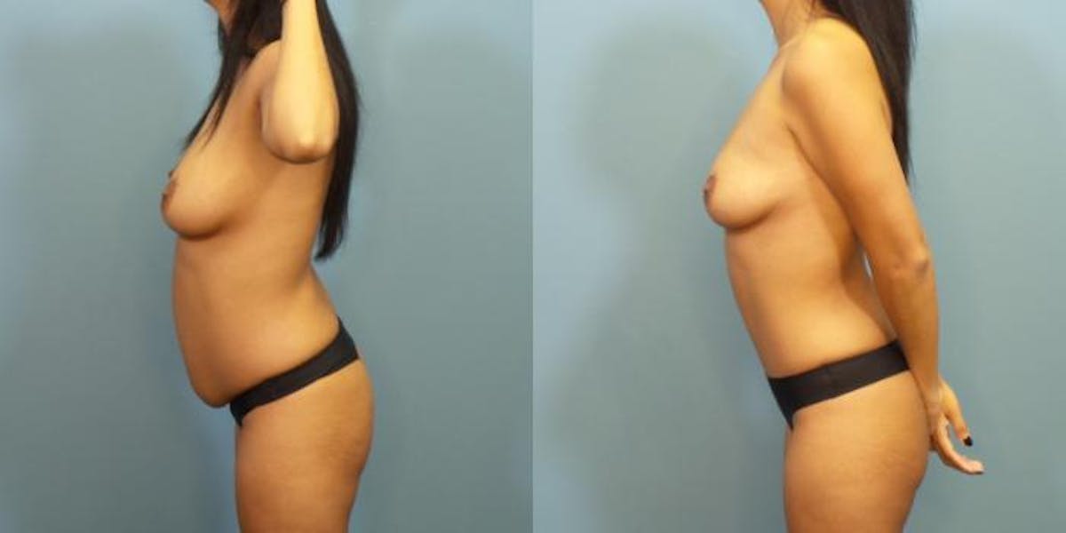 Tummy Tuck (Abdominoplasty) Before & After Gallery - Patient 306914 - Image 3