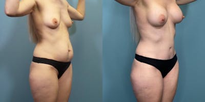 Tummy Tuck (Abdominoplasty) Before & After Gallery - Patient 240651 - Image 2