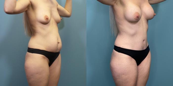 Tummy Tuck (Abdominoplasty) Before & After Gallery - Patient 240651 - Image 2