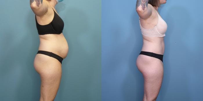 Tummy Tuck (Abdominoplasty) Before & After Gallery - Patient 251202 - Image 1