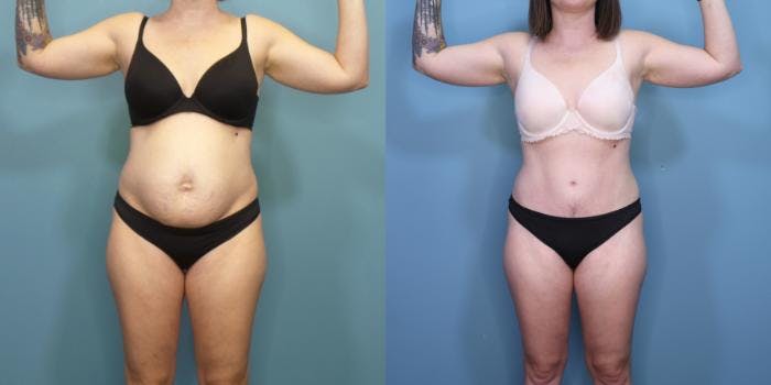 Tummy Tuck (Abdominoplasty) Before & After Gallery - Patient 251202 - Image 2