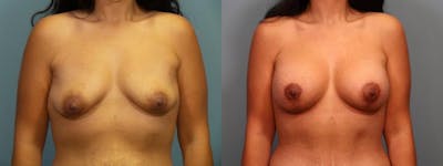 Tummy Tuck (Abdominoplasty) Before & After Gallery - Patient 157777 - Image 1