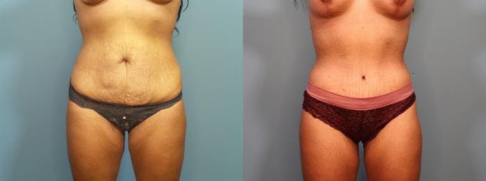 Tummy Tuck (Abdominoplasty) Before & After Gallery - Patient 157777 - Image 3