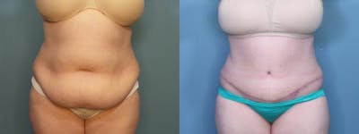 Tummy Tuck (Abdominoplasty) Before & After Gallery - Patient 137140 - Image 1