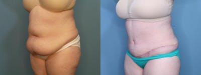 Tummy Tuck (Abdominoplasty) Before & After Gallery - Patient 137140 - Image 2