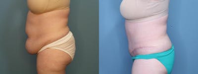 Tummy Tuck (Abdominoplasty) Before & After Gallery - Patient 137140 - Image 3