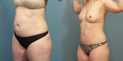 Tummy Tuck (Abdominoplasty) Before & After Gallery - Patient 363638 - Image 1