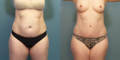 Tummy Tuck (Abdominoplasty) Before & After Gallery - Patient 363638 - Image 2