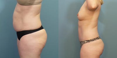 Tummy Tuck (Abdominoplasty) Before & After Gallery - Patient 363638 - Image 3