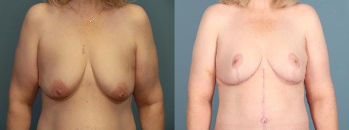 Tummy Tuck (Abdominoplasty) Before & After Gallery - Patient 674251 - Image 3