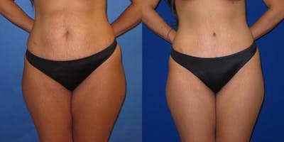 Tummy Tuck (Abdominoplasty) Before & After Gallery - Patient 941021 - Image 1