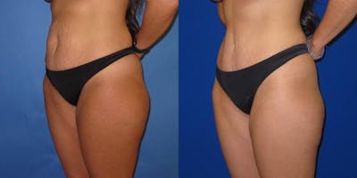 Tummy Tuck (Abdominoplasty) Before & After Gallery - Patient 941021 - Image 2