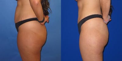 Tummy Tuck (Abdominoplasty) Before & After Gallery - Patient 941021 - Image 3