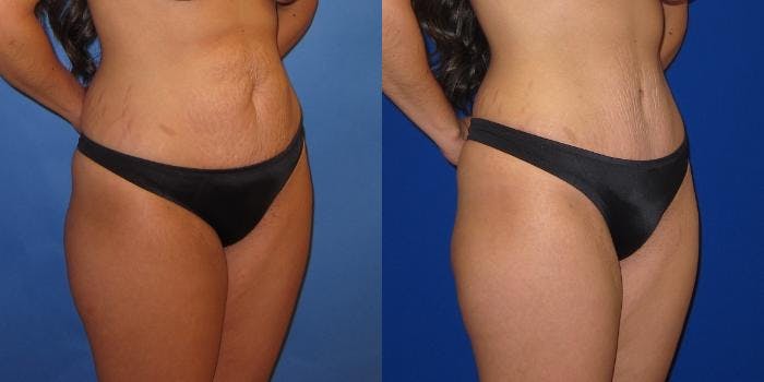Tummy Tuck (Abdominoplasty) Before & After Gallery - Patient 941021 - Image 4