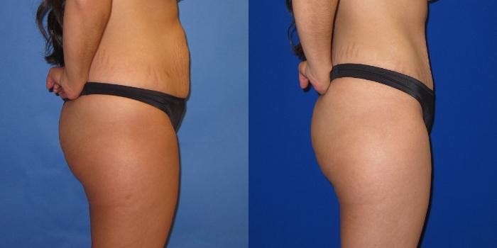 Tummy Tuck (Abdominoplasty) Before & After Gallery - Patient 941021 - Image 5