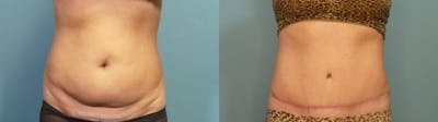 Tummy Tuck (Abdominoplasty) Before & After Gallery - Patient 218996 - Image 1