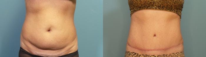 Tummy Tuck (Abdominoplasty) Before & After Gallery - Patient 218996 - Image 1
