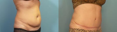 Tummy Tuck (Abdominoplasty) Before & After Gallery - Patient 218996 - Image 2