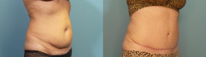 Tummy Tuck (Abdominoplasty) Before & After Gallery - Patient 218996 - Image 2