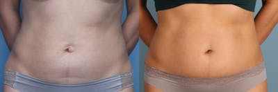 Tummy Tuck (Abdominoplasty) Before & After Gallery - Patient 219652 - Image 1