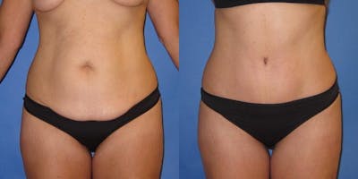 Tummy Tuck (Abdominoplasty) Before & After Gallery - Patient 320401 - Image 1