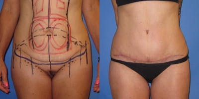 Tummy Tuck (Abdominoplasty) Before & After Gallery - Patient 320401 - Image 2
