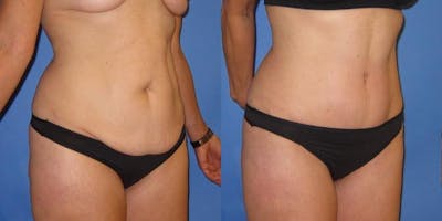 Tummy Tuck (Abdominoplasty) Before & After Gallery - Patient 320401 - Image 3
