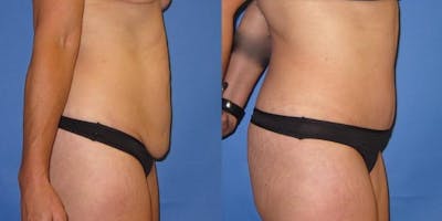 Tummy Tuck (Abdominoplasty) Before & After Gallery - Patient 320401 - Image 4